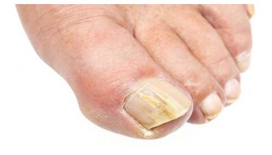 foot and nail fungus